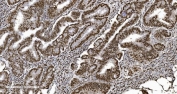 IHC staining of FFPE human rectal cancer tissue with Ku70/XRCC6 antibody. HIER: boil tissue sections in pH8 EDTA for 20 min and allow to cool before testing.