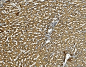 IHC staining of FFPE human liver cancer with PHB antibody. HIER: boil tissue sections in pH8 EDTA for 20 min and allow to cool before testing.