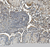 IHC staining of FFPE human lung cancer with PHB antibody. HIER: boil tissue sections in pH8 EDTA for 20 min and allow to cool before testing.