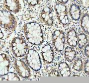 IHC staining of FFPE human colon cancer with PHB antibody. HIER: boil tissue sections in pH8 EDTA for 20 min and allow to cool before testing.