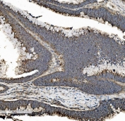 IHC staining of FFPE human rectal cancer tissue with PHB antibody. HIER: boil tissue sections in pH8 EDTA for 20 min and allow to cool before testing.