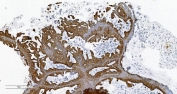 IHC staining of FFPE human ovarian cancer with Phospholipid transfer protein antibody. HIER: boil tissue sections in pH8 EDTA for 20 min and allow to cool before testing.