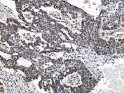 IHC staining of FFPE human ovarian serous adenocarcinoma tissue with PRDM14 antibody. HIER: boil tissue sections in pH8 EDTA for 20 min and allow to cool before testing.