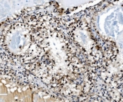 IHC staining of FFPE human renal clear cell carcinoma tissue with PRDM14 antibody. HIER: boil tissue sections in pH8 EDTA for 20 min and allow to cool before testing.