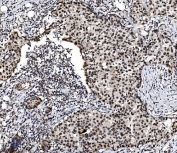 IHC staining of FFPE human breast cancer with PRDM14 antibody. HIER: boil tissue sections in pH8 EDTA for 20 min and allow to cool before testing.