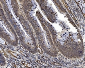 IHC staining of FFPE human rectal cancer tissue with PRDM14 antibody. HIER: boil tissue sections in pH8 EDTA for 20 min and allow to cool before testing.