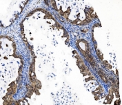 IHC staining of FFPE human ovarian cancer tissue with PRDM14 antibody. HIER: boil tissue sections in pH8 EDTA for 20 min and allow to cool before testing.