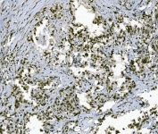 IHC staining of FFPE human gastric adenocarcinoma tissue with TBP associated factor 4 antibody. HIER: boil tissue sections in pH8 EDTA for 20 min and allow to cool before testing.