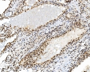 IHC staining of FFPE human renal clear cell carcinoma tissue with TBP associated factor 4 antibody. HIER: boil tissue sections in pH8 EDTA for 20 min and allow to cool before testing.