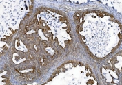 IHC staining of FFPE human ovarian cancer tissue with ZO2 antibody. HIER: boil tissue sections in pH8 EDTA for 20 min and allow to cool before testing.