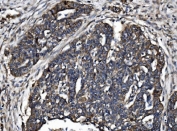 IHC staining of FFPE human ovarian serous adenocarcinoma tissue with ZO2 antibody. HIER: boil tissue sections in pH8 EDTA for 20 min and allow to cool before testing.