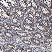 IHC staining of FFPE human rectal cancer tissue with ZO2 antibody. HIER: boil tissue sections in pH8 EDTA for 20 min and allow to cool before testing.