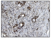 IHC staining of FFPE human breast cancer with VAMP4 antibody. HIER: boil tissue sections in pH8 EDTA for 20 min and allow to cool before testing.