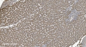 IHC staining of FFPE human liver cancer tissue with SHMT antibody. HIER: boil tissue sections in pH8 EDTA for 20 min and allow to cool before testing.