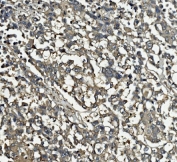 IHC staining of FFPE human pancreatic cancer tissue with Clathrin heavy chain antibody. HIER: boil tissue sections in pH8 EDTA for 20 min and allow to cool before testing.