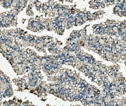 IHC staining of FFPE human renal carcinoma tissue with Clathrin heavy chain antibody. HIER: boil tissue sections in pH8 EDTA for 20 min and allow to cool before testing.