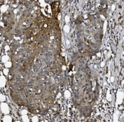 IHC staining of FFPE human breast cancer tissue with ACVRL1 antibody. HIER: boil tissue sections in pH8 EDTA for 20 min and allow to cool before testing.