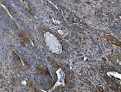 IHC staining of FFPE human gallbladder adenocarcinoma tissue with ACVRL1 antibody. HIER: boil tissue sections in pH8 EDTA for 20 min and allow to cool before testing.