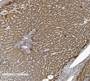 IHC staining of FFPE human liver cancer tissue with ACVRL1 antibody. HIER: boil tissue sections in pH8 EDTA for 20 min and allow to cool before testing.