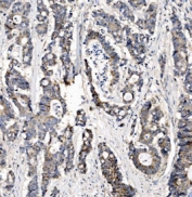 IHC staining of FFPE human colonic adenocarcinoma tissue with CHCHD10 antibody. HIER: boil tissue sections in pH8 EDTA for 20 min and allow to cool before testing.