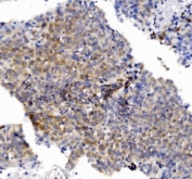 IHC staining of FFPE human lung cancer tissue with CHCHD10 antibody. HIER: boil tissue sections in pH8 EDTA for 20 min and allow to cool before testing.