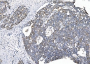 IHC staining of FFPE human ovarian serous adenocarcinoma tissue with CHCHD10 antibody. HIER: boil tissue sections in pH8 EDTA for 20 min and allow to cool before testing.