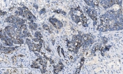 IHC staining of FFPE human gallbladder adenocarcinoma tissue with CHCHD10 antibody. HIER: boil tissue sections in pH8 EDTA for 20 min and allow to cool before testing.