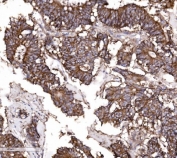 IHC staining of FFPE human colonic adenocarcinoma tissue with Claudin 3 antibody. HIER: boil tissue sections in pH8 EDTA for 20 min and allow to cool before testing.