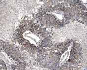 IHC staining of FFPE human liver cancer tissue with Claudin 3 antibody. HIER: boil tissue sections in pH8 EDTA for 20 min and allow to cool before testing.