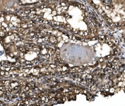 IHC staining of FFPE human renal clear cell carcinoma tissue with Claudin 3 antibody. HIER: boil tissue sections in pH8 EDTA for 20 min and allow to cool before testing.