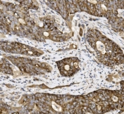 IHC staining of FFPE human gallbladder adenocarcinoma tissue with Claudin 3 antibody. HIER: boil tissue sections in pH8 EDTA for 20 min and allow to cool before testing.