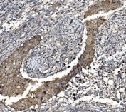 IHC staining of FFPE human breast invasive ductal cancer tissue with Claudin 3 antibody. HIER: boil tissue sections in pH8 EDTA for 20 min and allow to cool before testing.