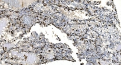 IHC staining of FFPE human renal clear cell carcinoma tissue with Coronin 1a antibody. HIER: boil tissue sections in pH8 EDTA for 20 min and allow to cool before testing.