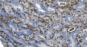 IHC staining of FFPE human gallbladder adenocarcinoma tissue with Coronin 1a antibody. HIER: boil tissue sections in pH8 EDTA for 20 min and allow to cool before testing.