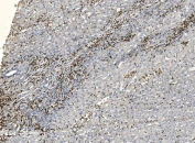 IHC staining of FFPE human liver cancer tissue with Coronin 1a antibody. HIER: boil tissue sections in pH8 EDTA for 20 min and allow to cool before testing.