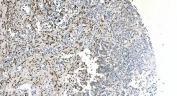 IHC staining of FFPE human gastric cancer tissue with Coronin 1a antibody. HIER: boil tissue sections in pH8 EDTA for 20 min and allow to cool before testing.