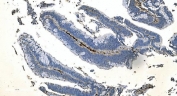 IHC staining of FFPE human colonic adenocarcinoma tissue with Coronin 1a antibody. HIER: boil tissue sections in pH8 EDTA for 20 min and allow to cool before testing.