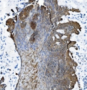 IHC staining of FFPE human ovarian adenocarcinoma tissue with DCTN1 antibody. HIER: boil tissue sections in pH8 EDTA for 20 min and allow to cool before testing.