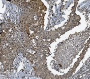 IHC staining of FFPE human breast cancer tissue with DCTN1 antibody. HIER: boil tissue sections in pH8 EDTA for 20 min and allow to cool before testing.