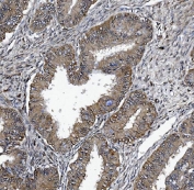 IHC staining of FFPE human rectal cancer tissue with DCTN1 antibody. HIER: boil tissue sections in pH8 EDTA for 20 min and allow to cool before testing.