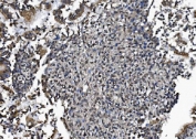 IHC staining of FFPE human lung cancer tissue with DCTN1 antibody. HIER: boil tissue sections in pH8 EDTA for 20 min and allow to cool before testing.