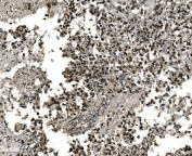 IHC staining of FFPE human gastric cancer tissue with FOXA2 antibody. HIER: boil tissue sections in pH8 EDTA for 20 min and allow to cool before testing.