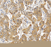IHC staining of FFPE human liver cancer tissue with Glutamic-oxaloacetic transaminase 1 antibody, HRP-secondary and DAB substrate. HIER: boil tissue sections in pH8 EDTA for 20 min and allow to cool before testing.