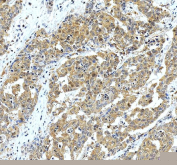 IHC staining of FFPE human liver cancer tissue with Glutamic-oxaloacetic transaminase 1 antibody, HRP-secondary and DAB substrate. HIER: boil tissue sections in pH8 EDTA for 20 min and allow to cool before testing.