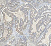 IHC staining of FFPE human colon cancer tissue with Glutamic-oxaloacetic transaminase 1 antibody, HRP-secondary and DAB substrate. HIER: boil tissue sections in pH8 EDTA for 20 min and allow to cool before testing.