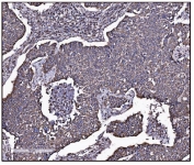 IHC staining of FFPE human lung cancer tissue with Glutamate-oxaloacetate transaminase 2 antibody. HIER: boil tissue sections in pH8 EDTA for 20 min and allow to cool before testing.