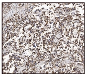 IHC staining of FFPE human gastric cancer tissue with Glutamate-oxaloacetate transaminase 2 antibody. HIER: boil tissue sections in pH8 EDTA for 20 min and allow to cool before testing.