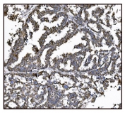 IHC staining of FFPE human ovarian cancer tissue with Glutamate-oxaloacetate transaminase 2 antibody. HIER: boil tissue sections in pH8 EDTA for 20 min and allow to cool before testing.
