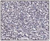 IHC staining of FFPE human renal carcinoma tissue with Glutamate-oxaloacetate transaminase 2 antibody. HIER: boil tissue sections in pH8 EDTA for 20 min and allow to cool before testing.