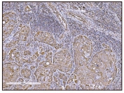 IHC staining of FFPE human gallbladder adenocarcinoma tissue with Glutamate-oxaloacetate transaminase 2 antibody. HIER: boil tissue sections in pH8 EDTA for 20 min and allow to cool before testing.